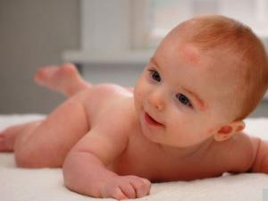 Лечение аллергии у новорождённых и грудничков: аптечные препараты и народные средства Снять зуд у младенца