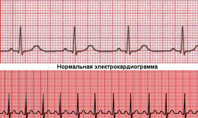 Учащенное сердцебиение: симптомы и лечение Сердцебиение высокое что принимать